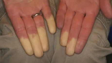 Syndrome de Raynaud
