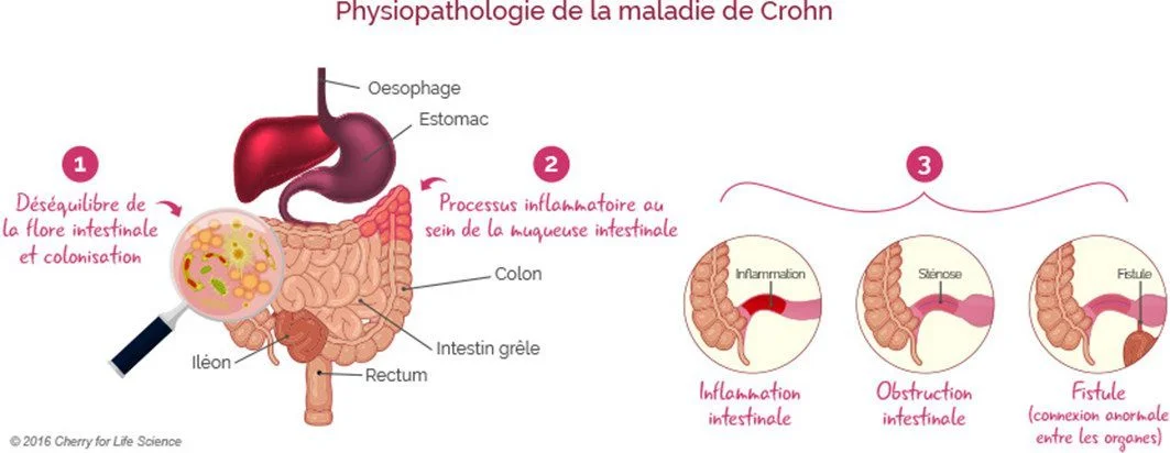 Physiopathologie maladie crohn médecine occidentale